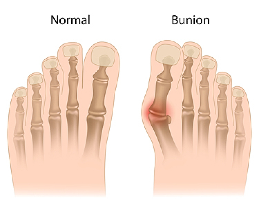 Why Bunions Form and How They Are Managed
