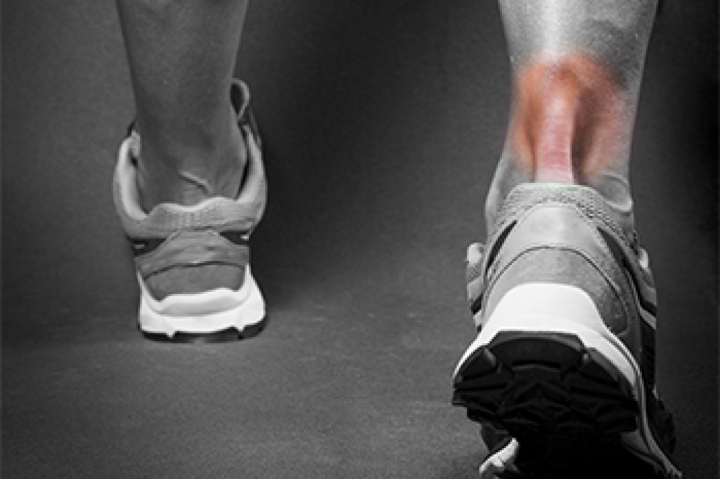 Managing an Achilles Tendon Rupture