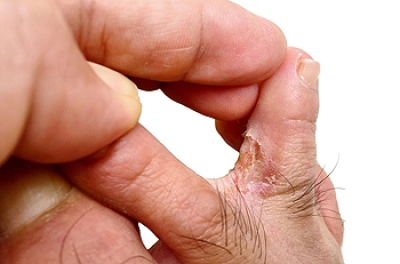 Understanding Athlete’s Foot and How to Treat It