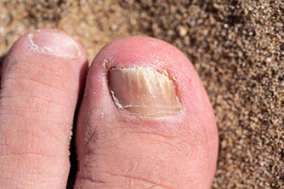 Facts About Toenail Fungus